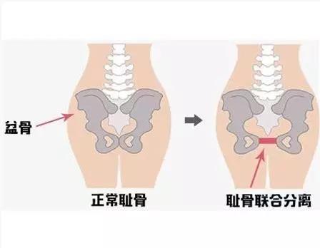 女性盆骨