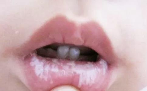 鹅口疮