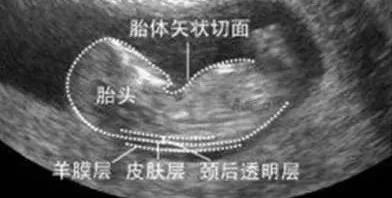 NT检查.jpg