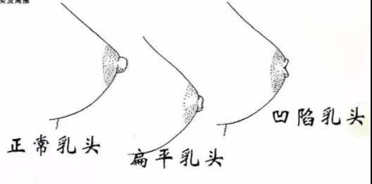 乳头异常.jpg
